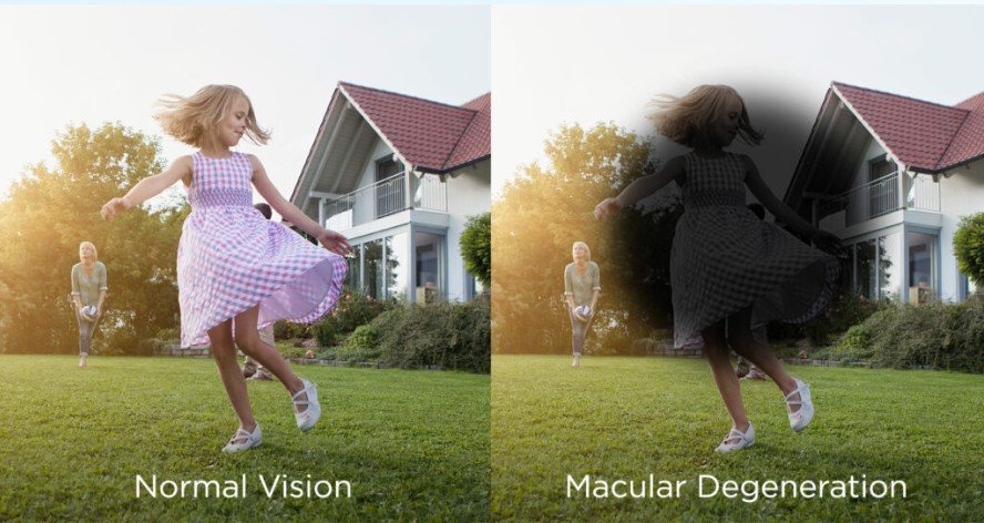 Macular Degeneration Presentation
