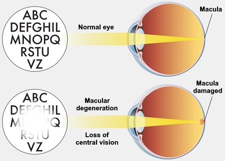 Macular Degeneration Diagram